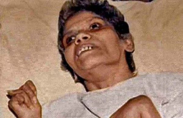 Médicos e enfermeiras do hospital onde Aruna Shanbaug ficou internada eram contra eutanásia