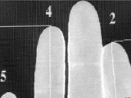 Tamanho do dedo anelar pode ajudar a revelar doena motora, diz estudo