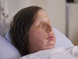 Nova face de mulher desfigurada aps ataque de chimpanz  revelada
