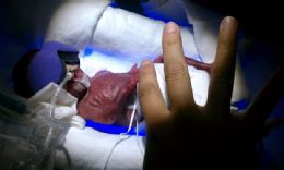 Beb sobrevive nos Estados Unidos aps nascer com apenas 270 gramas