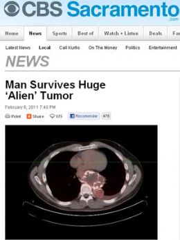 Homem vive 10 anos com tumor do tamanho de bola de futebol nos EUA