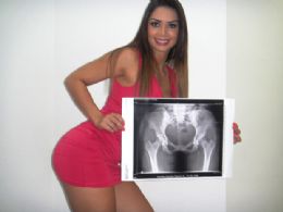 Candidata ao Miss Bumbum Brasil tira raio-x para provar que derrire  natural