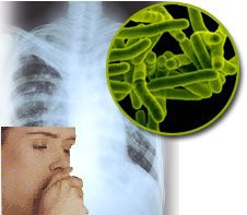 Tuberculose em Cuiab est acima da mdia