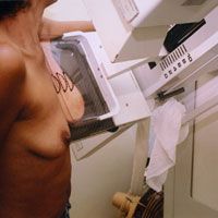 Mdicos e pacientes ainda se dividem sobre mamografia