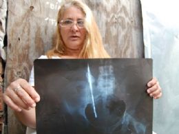 Mulher diz que vive h quase 30 anos com tesoura esquecida na barriga