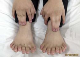 Cirurgia retira 11 dedos adicionais de chins de 6 anos