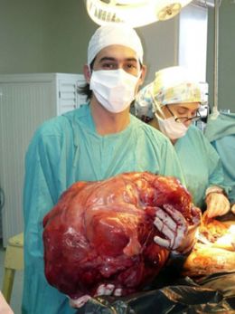 Mdicos argentinos removem com sucesso tumor de 23 quilos