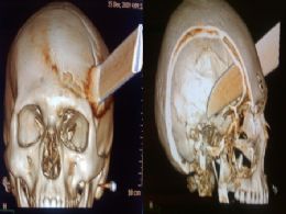 Tomografia do crnio do rapaz mostra que faca perfurou crebro