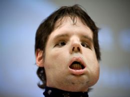 Mdicos mostram paciente que fez transplante total de rosto na Espanha