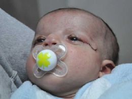 Pele tirada em circunciso salva viso de beb israelense sem plpebras
