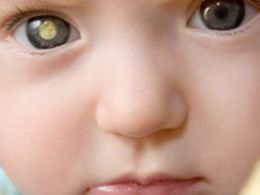 Brilho diferente em olho leva a diagnstico de cncer em beb