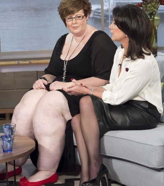 Doena faz mulher ter 63 kg apenas nas pernas e mdicos erram por anos ao dizer que ela estava apenas gorda