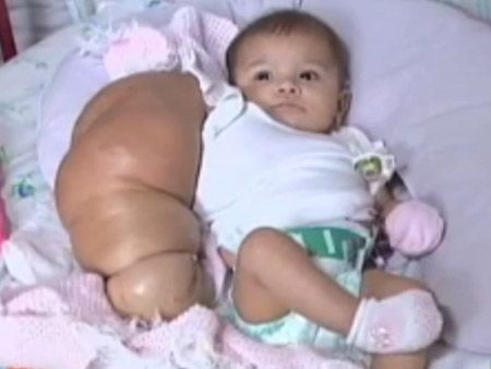 Nicole, a beb com brao gigante, morre aos 6  meses no Rio de Janeiro