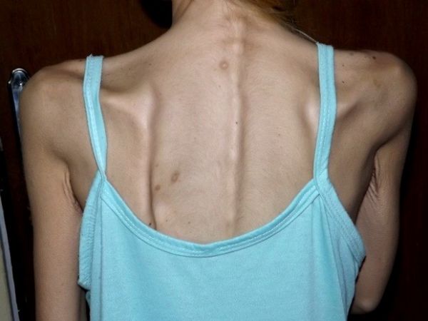 Mulher de 34 anos sofre de anorexia nervosa e pesa 24 kg em Bauru