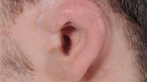 Implante de aparelho e orelha feita de osso devolvem audio a escocs