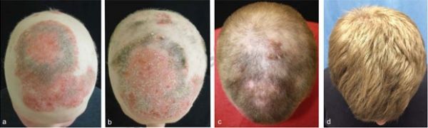 Imagens mostram evoluo do quadro de alopcia aps tratamento com droga
