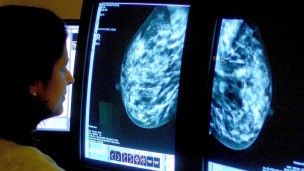 Cientistas desenvolvem exame para sete tipos de cncer de mama
