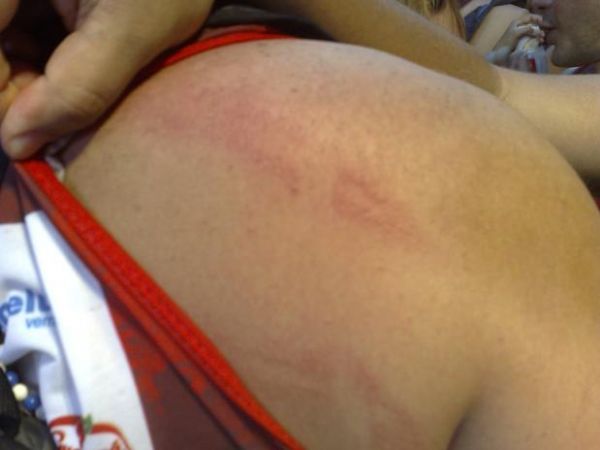 Foilo mostra marca vermelha nas costas aps apanhar de PM em Salvador