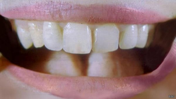 Chineses recriam 'dente' a partir da urina humana