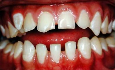 cido acetilsaliclico pode causar eroso dentria