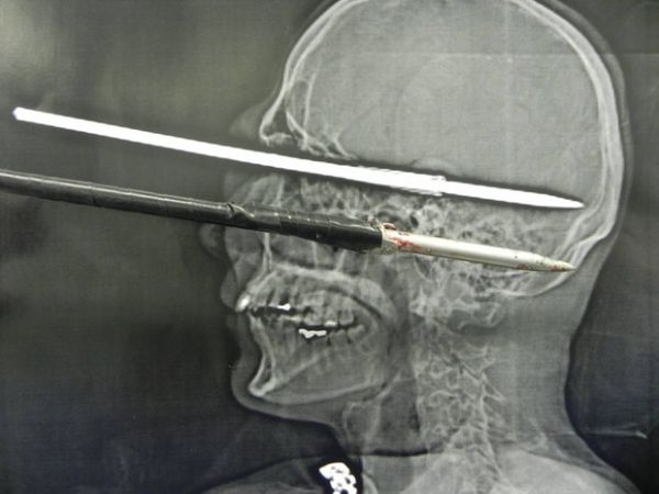 Hospital divulga imagem de arpo na cabea de homem em Petrpolis, RJ