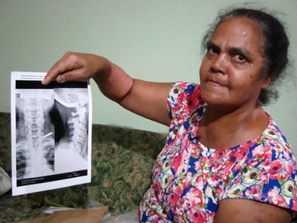 Mulher descobre que viveu com pedao de faca no ombro por 37 anos