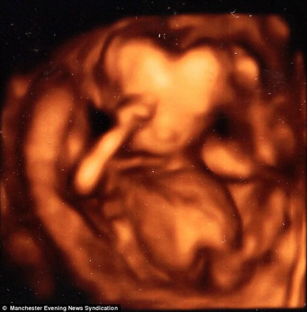 Exame de ultrassom deixa grvida chocada ao mostrar beb com cabea em formato de corao