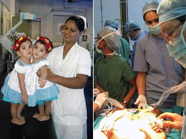 Gmeas siamesas de 1 ano de idade so separadas em cirurgia na ndia