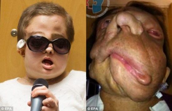 Mulher de 26 anos, que teve o rosto desfigurado por tumor, revela nova face aps transplante