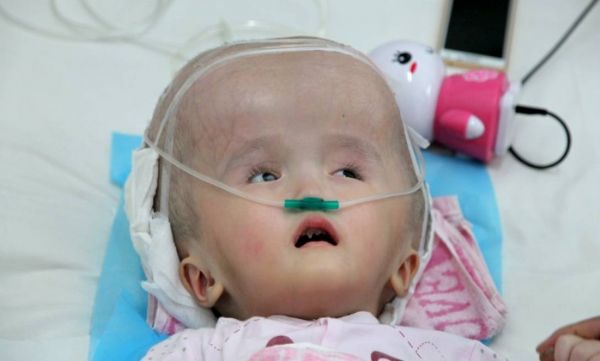 Han Han, de 3 anos, sofre de hidrocefalia, acmulo de lquido dentro do crnio, e passou por cirurgia para implantar trs peas de titnio para substituir seu crnio
