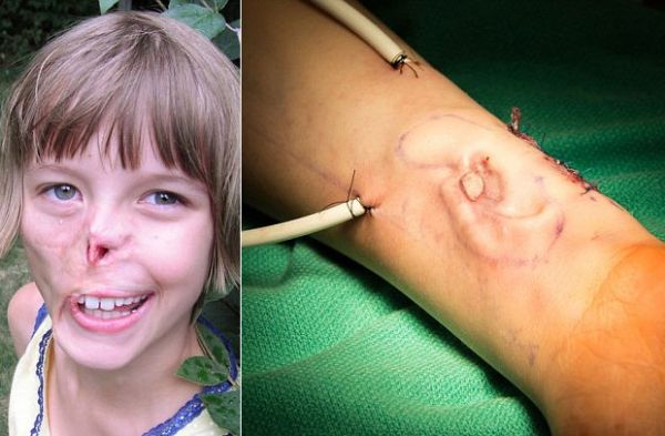 Menina de 12 anos que perdeu a orelha em ataque de guaxinim tem novo rgo crescido em seu brao