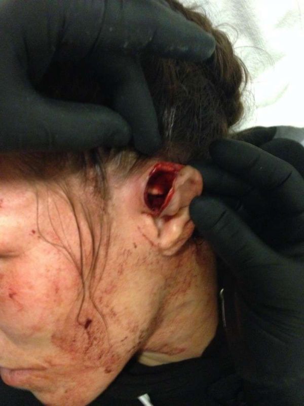 Imagens fortes: lutadora do UFC mostra estrago em orelha