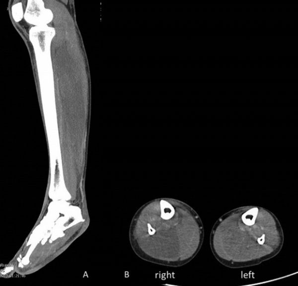 Tomografia computadorizada da perna direita da paciente mostra inchao dos msculos
