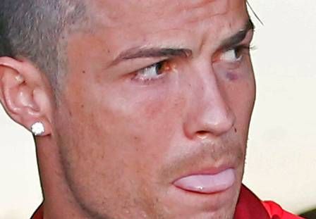 Cristiano Ronaldo e o seu olho roxo