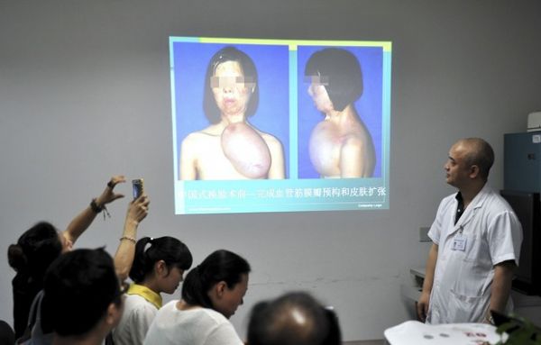 Mdicos chineses 'cultivam' rosto de jovem em seu peito para transplante