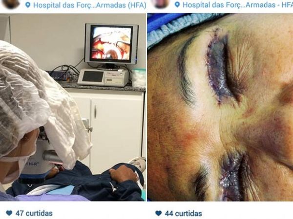 Na primeira imagem, oftalmologista faz cirurgia para retirada de membrana de olho em Braslia; na segunda, paciente est com os olhos ainda inchados aps plstica nas plpebras