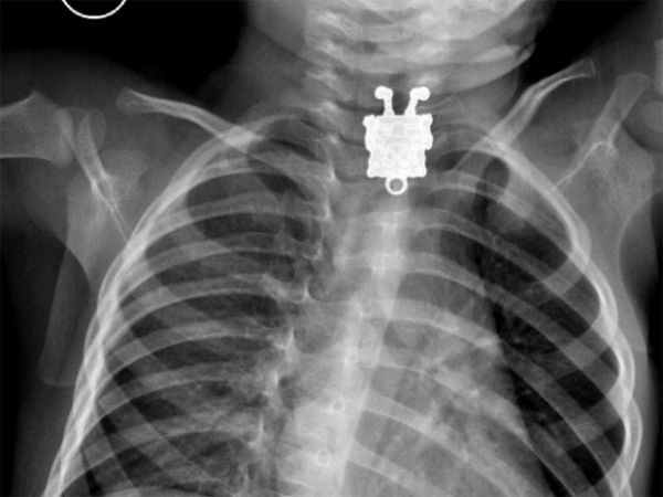Radiografia revela Bob Esponja no esfago de garoto de 1 ano