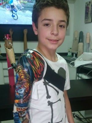 Menino atacado por tigre ganha prtese com desenho personalizado