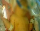 Beb tem a perna amputada em hospital pblico do Rio