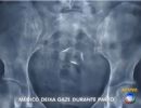 Compressa de gaze  esquecida na barriga de mulher durante parto